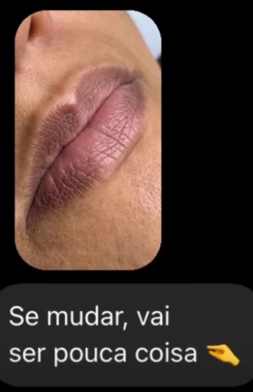 Antes e Depois do Kit para Microagulhamento Labial Hydra Gloss Lips!