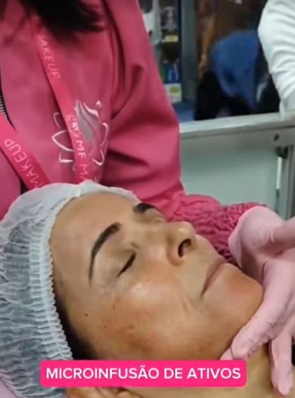 Microinfusão de Ativos na Pele com Marvel: 4 Procedimentos!